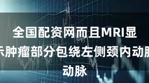 全国配资网而且MRI显示肿瘤部分包绕左侧颈内动脉
